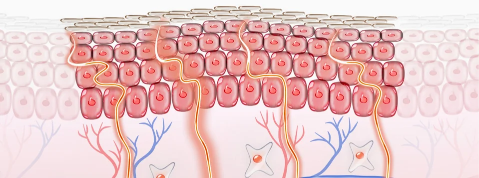 Illustrated section of sensitive skin
